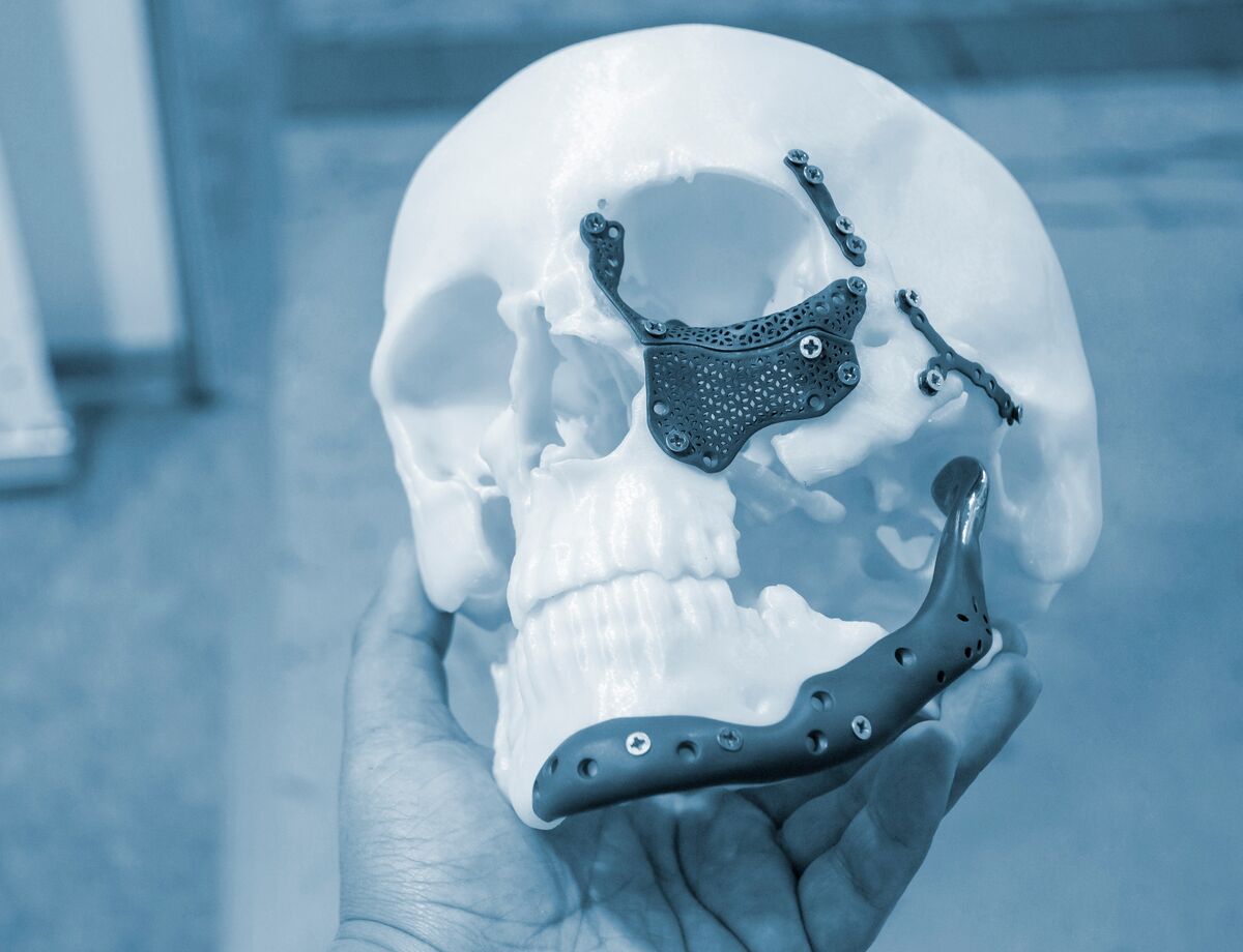 A gloved hand holding an anatomical skull model fitted with titanium reconstruction plates.